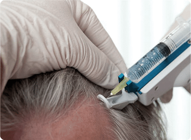 mesotherapy-for-hair-loss-treatment-injection